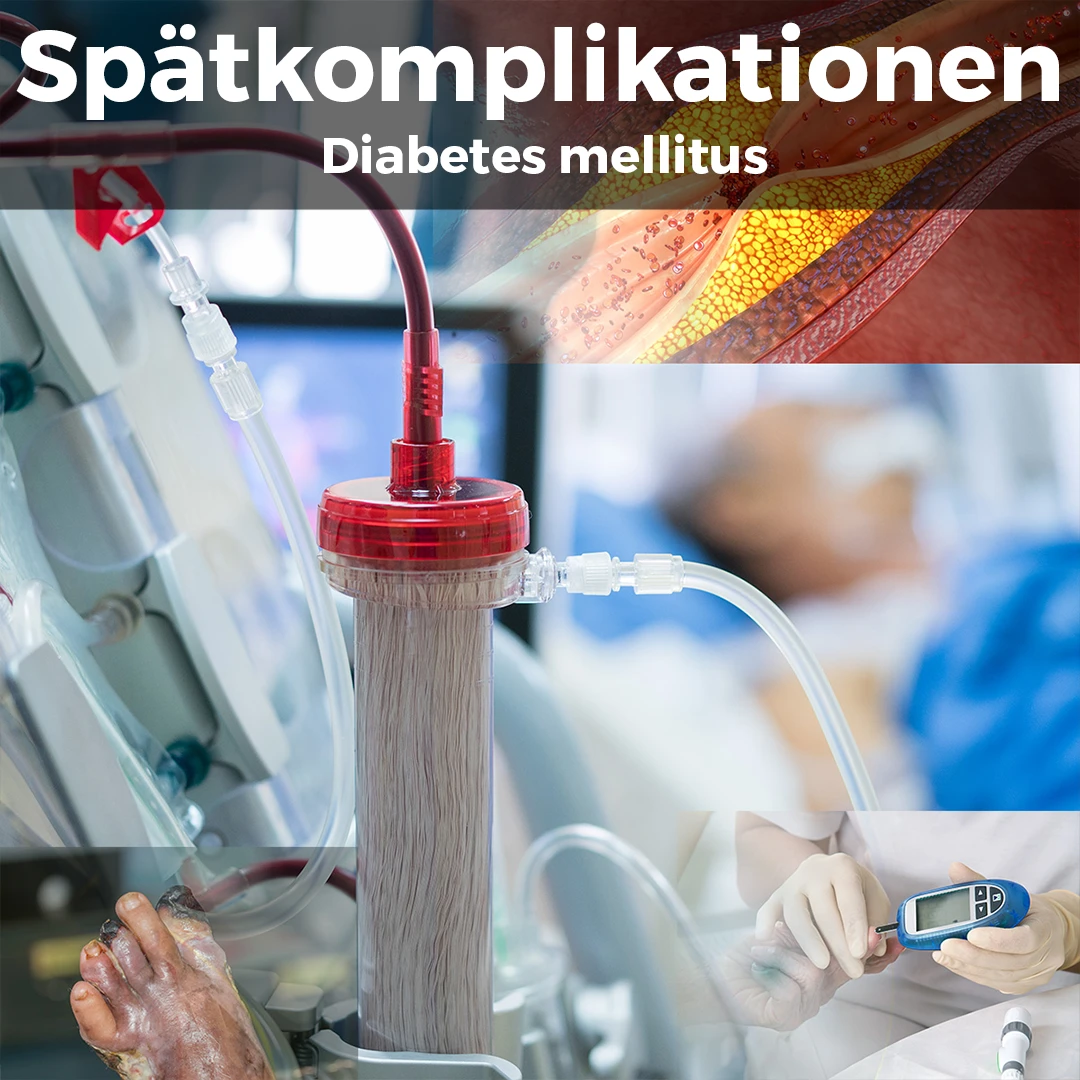 Bildcollage aus verengter Arterie mit Fettablagerungen, Dialysefilter am Krankenbett, Blutzuckermessung mit Handschuh und geschädigten Füßen – Folgeschäden dauerhaft erhöhter Blutzuckerwerte